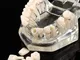 Transparent Dental Implantation Dente Dente Denti Modello Teaching Denti Tool Utensile Den...