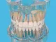 WJH Denti Modello - Trasparente Patologica Tooth Modello - Parodontologia Medical Strument...